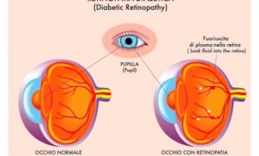 Isernia, giornata mondiale della vista: seminario sulla retinopatia diabetica