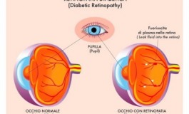 Isernia, giornata mondiale della vista: seminario sulla retinopatia diabetica